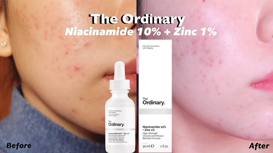Conoce los mejores productos The Ordinary para el Acne Veridico Shop